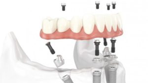 PRÓTESIS DENTAL FIJA