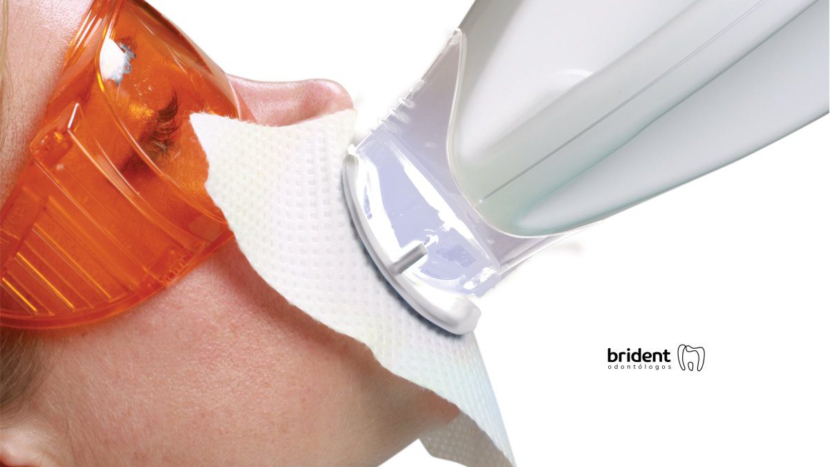 blanqueamiento dental tenerife