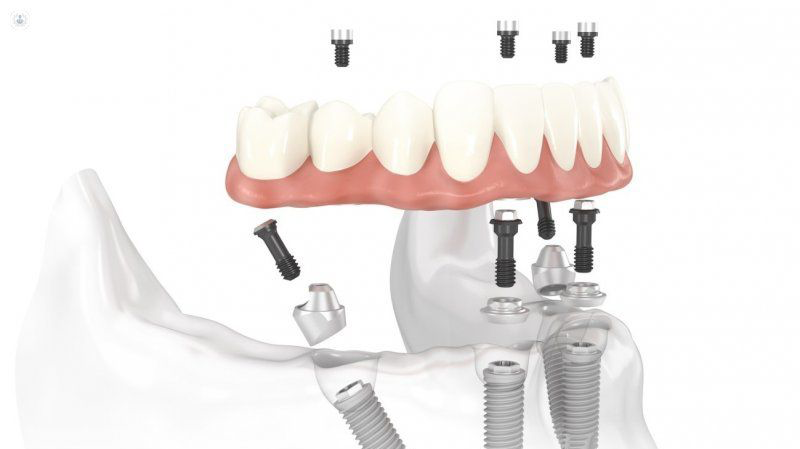 Implantes-Dentales-Tenerife