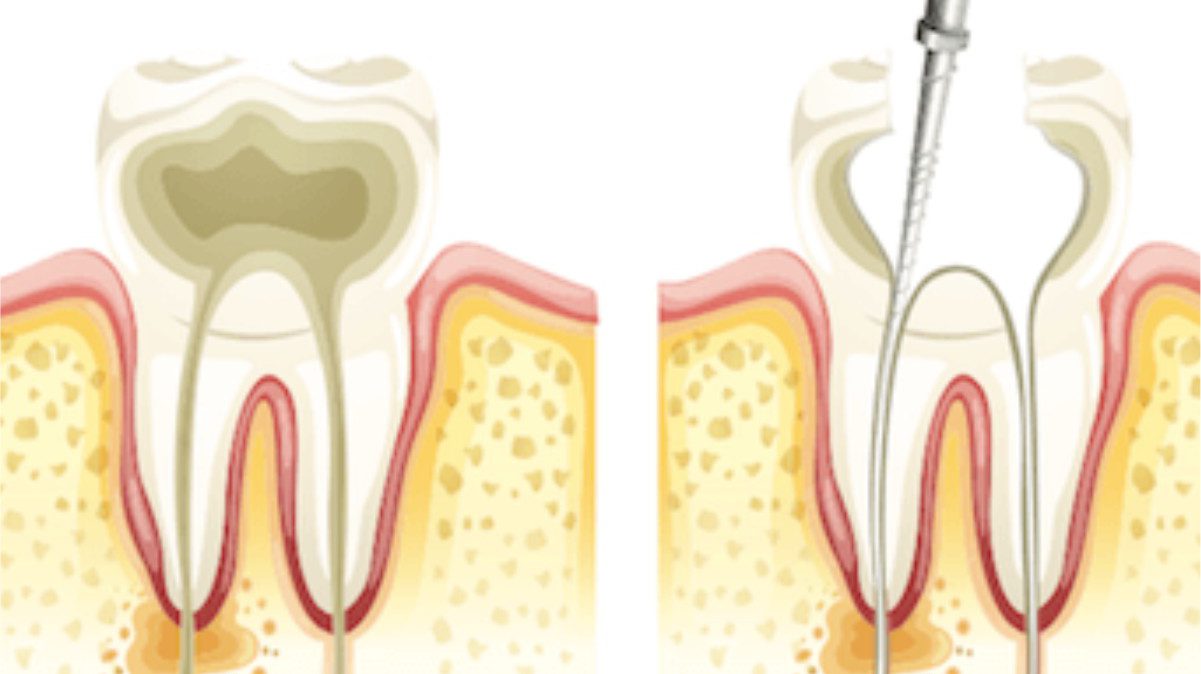 endodoncia-multirradicular