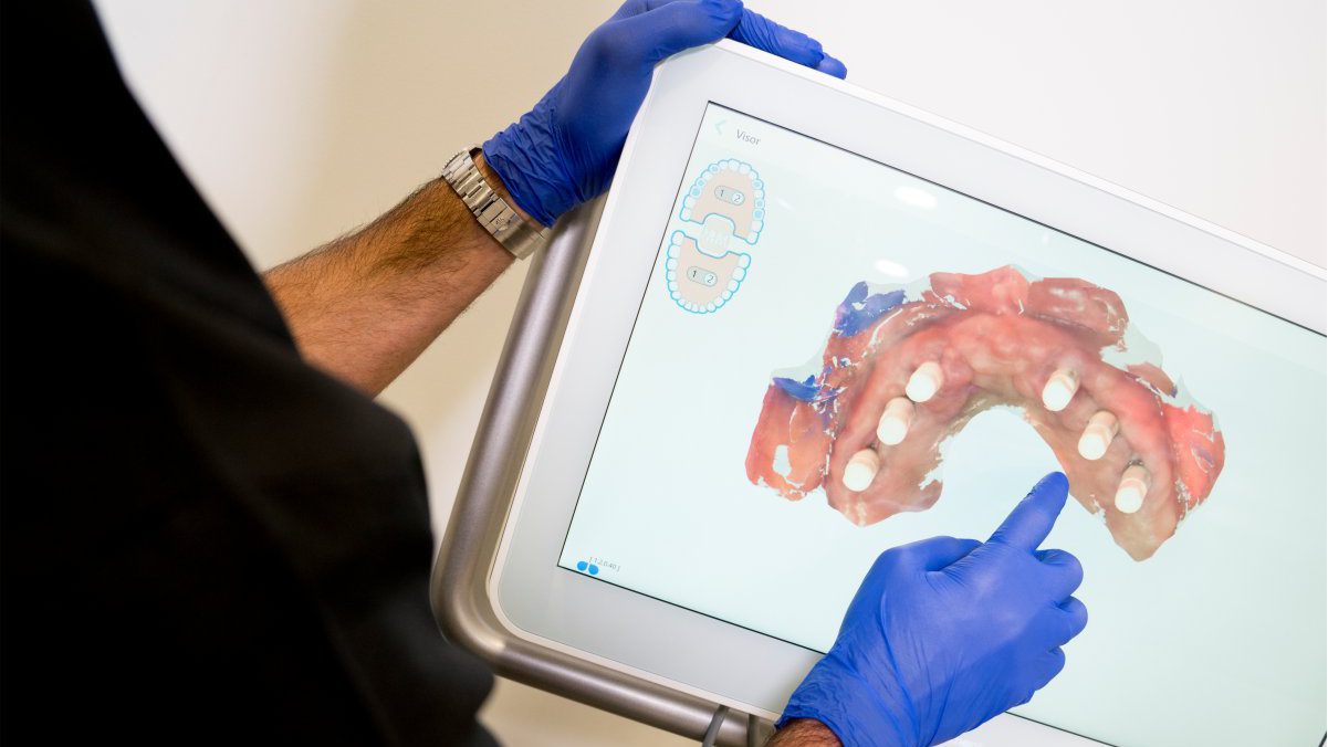 implantes-dentales-tenerife