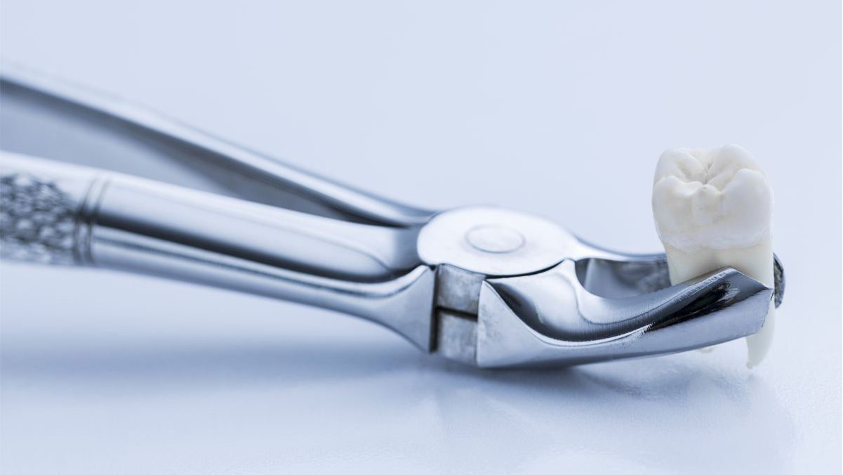 extracciones dentales