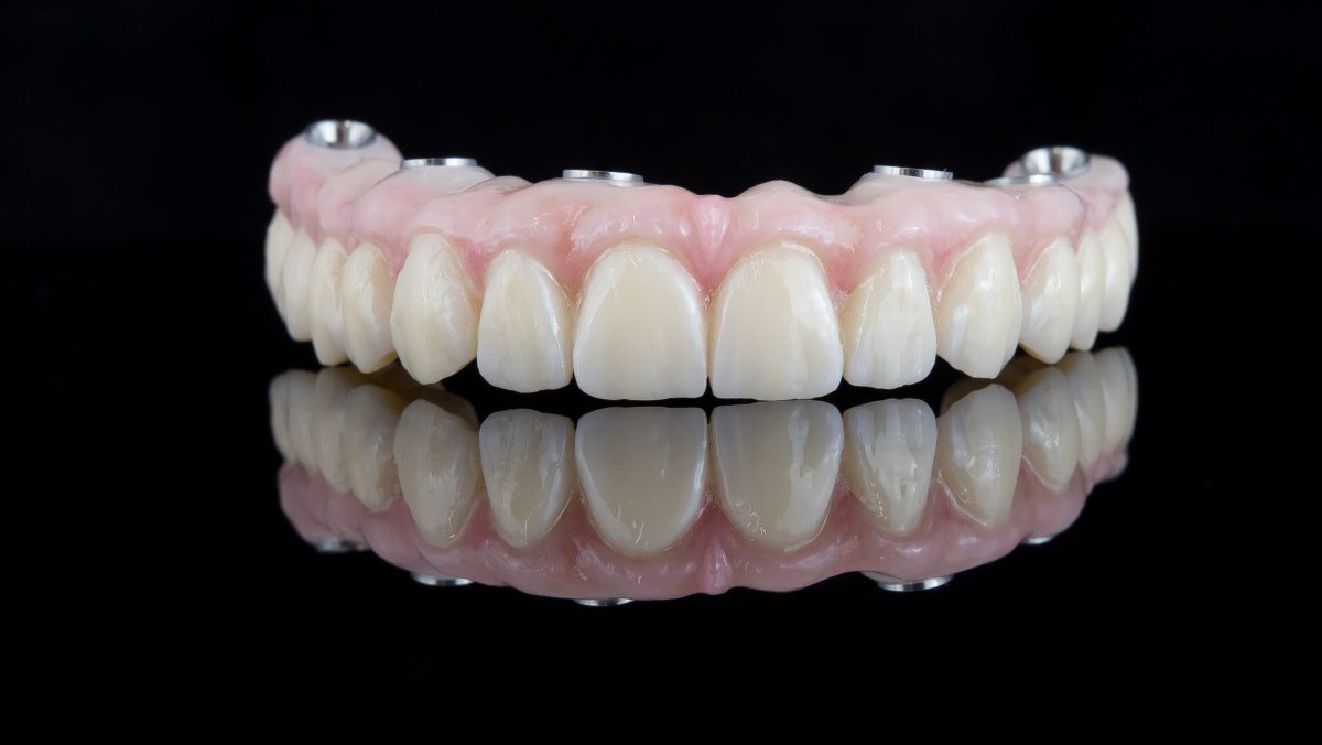 PRÓTESIS DENTALES SOBRE IMPLANTES