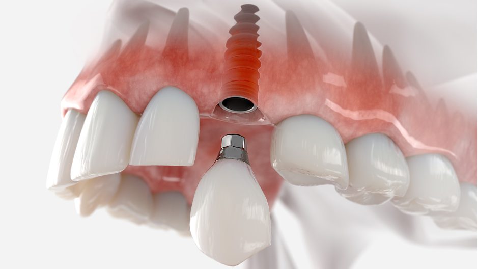implantes-de-carga-inmediata