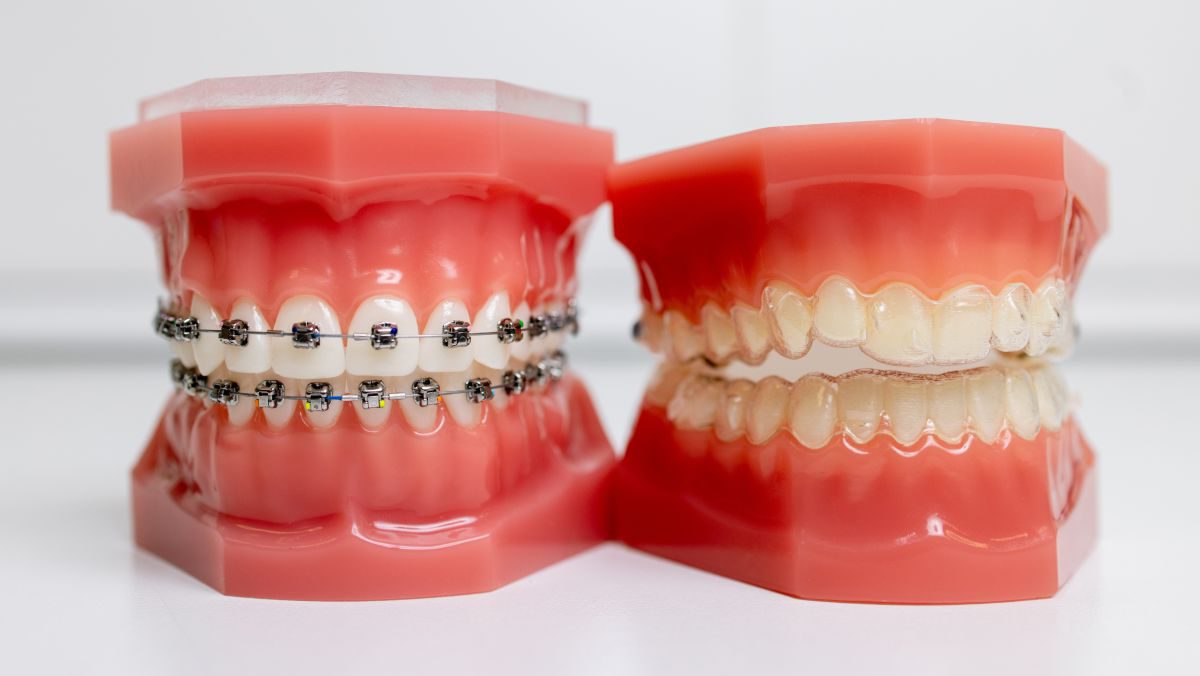 invisalign tenerife ortodoncia con brackets