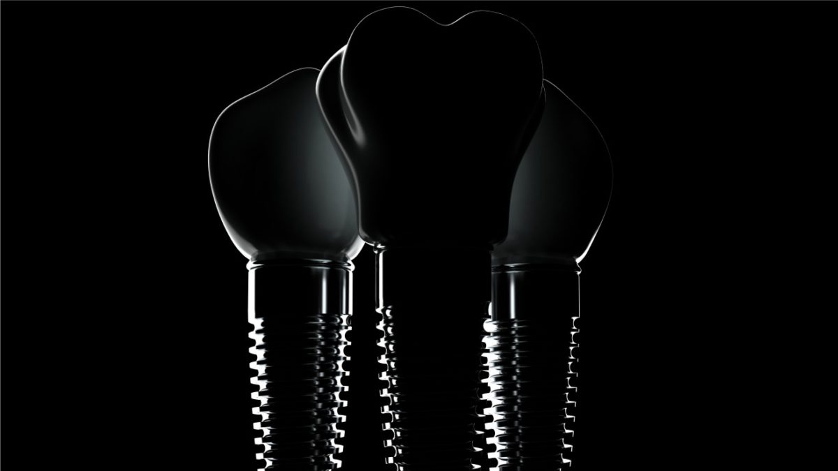 implantes dentales