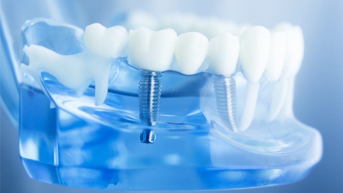 implantes-dentales