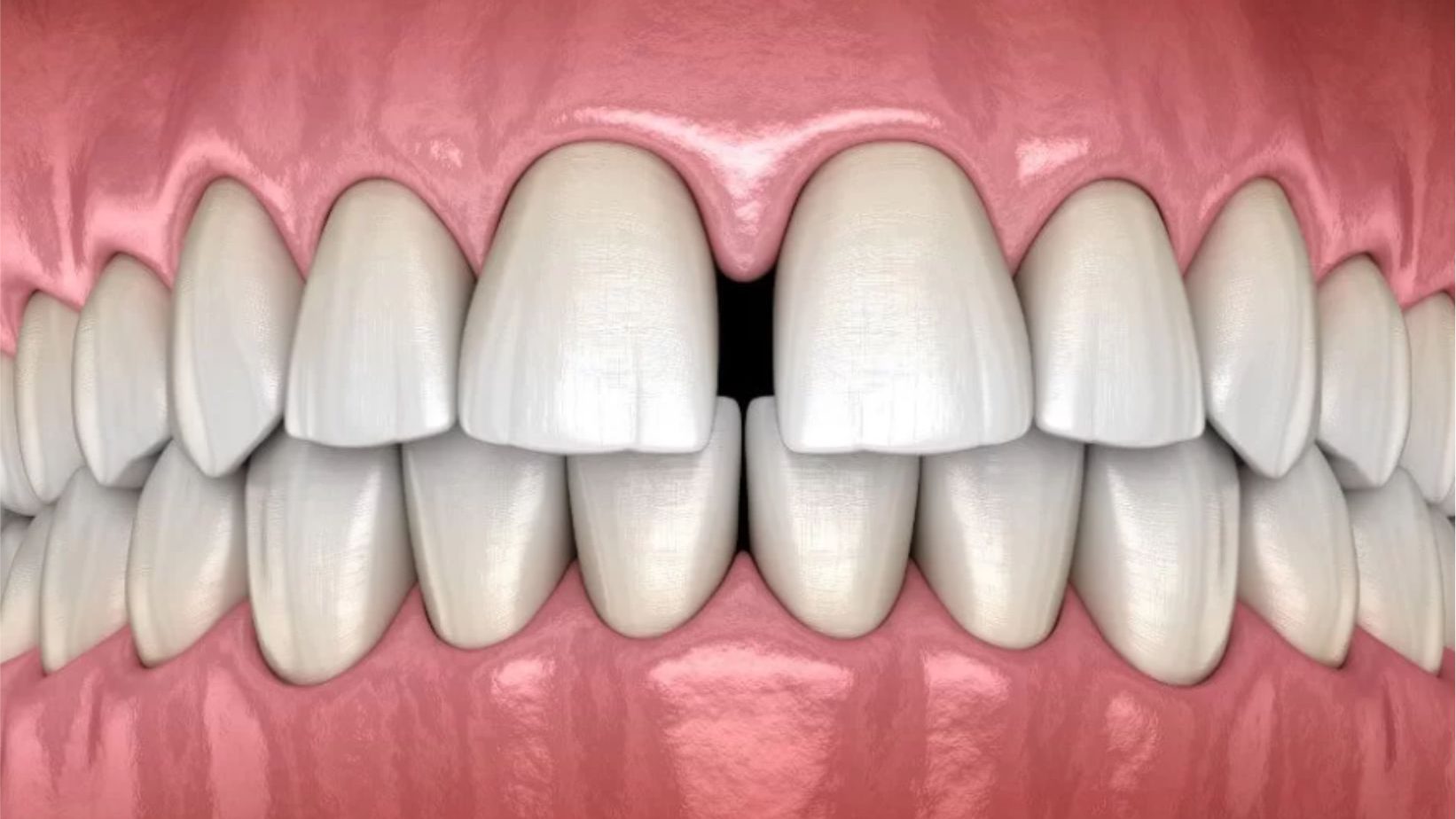 diastema clinica dental brident odontologos-1