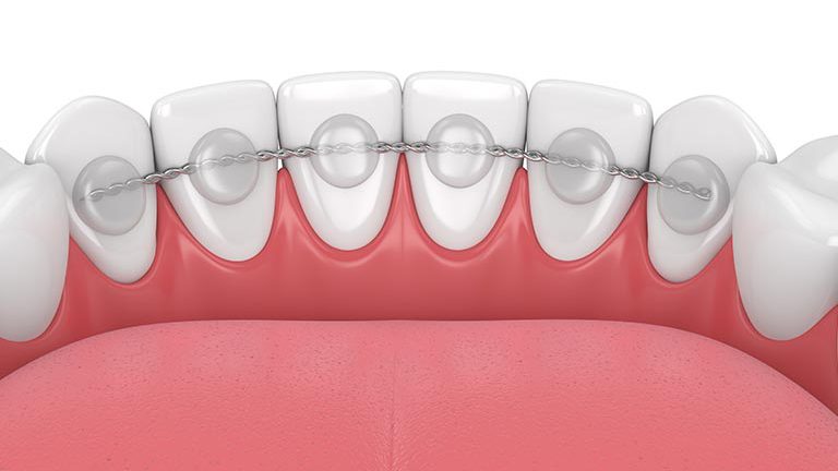 retenedores-dentales