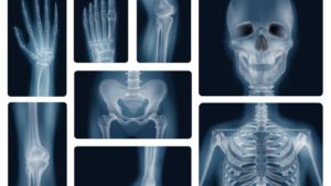osteoporosis y salud dental