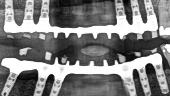 Implantes dentales en un día