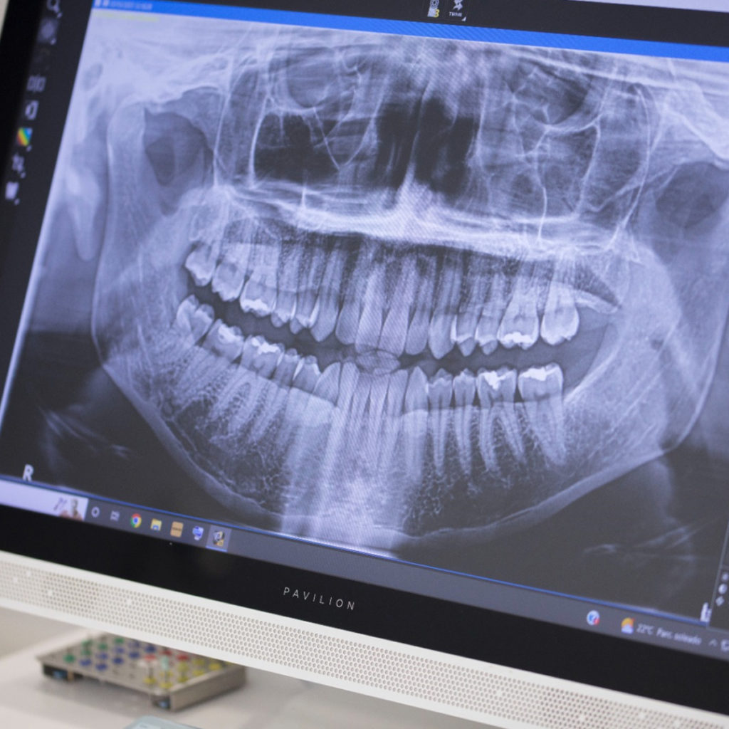 Salvamos dientes comprometidos