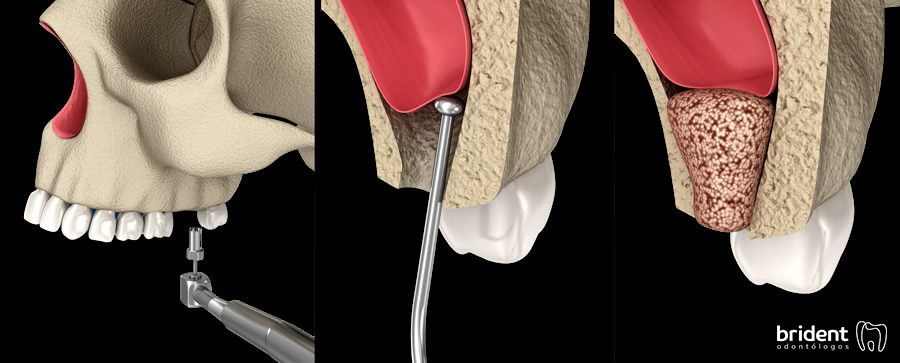 ELEVACIÓN DE SENO MAXILAR, BRIDENT, TENERIFE