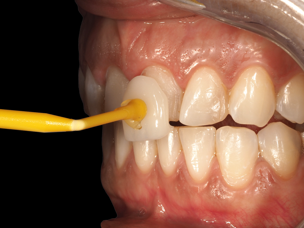 carilla dental Tenerife