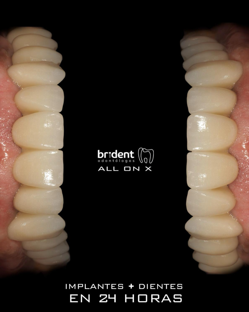 Implantes dentales + dientes en 24 horas