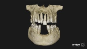 Enfermedad periodontal