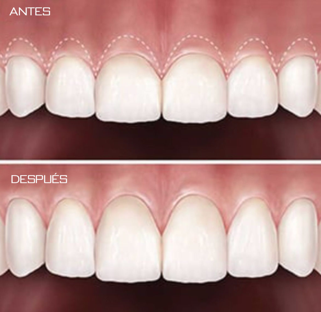 Alargamiento coronario, Brident Odontólogos