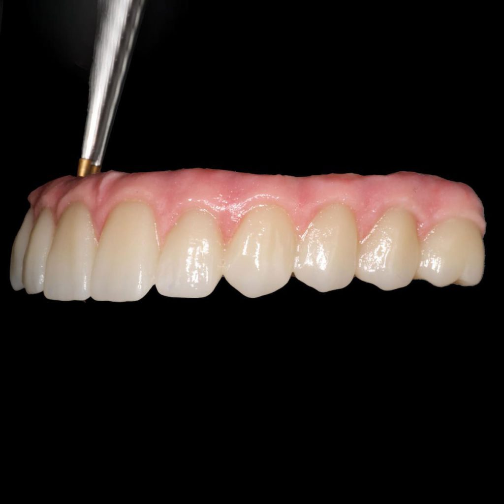 Pretesis dentales sobre implantes