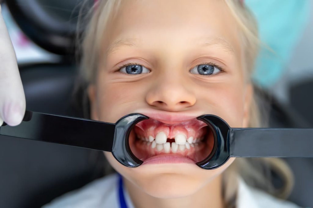 Diastema dental en niños