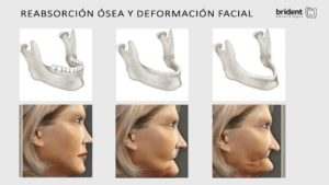 reabsorción ósea