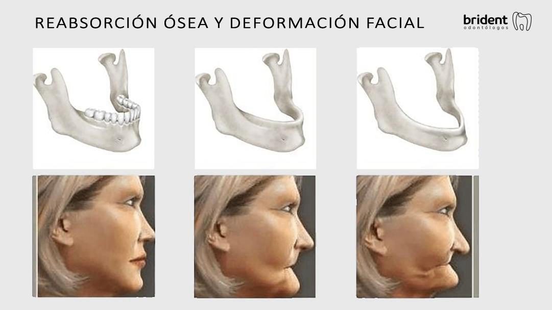 Reabsorción ósea