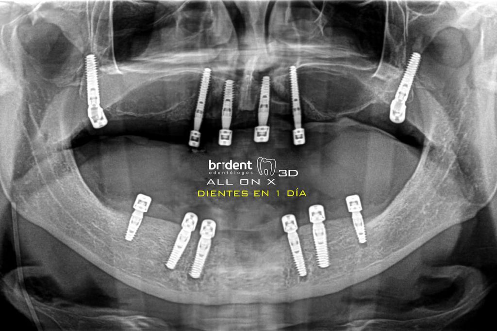 All-on-x dientes en un día