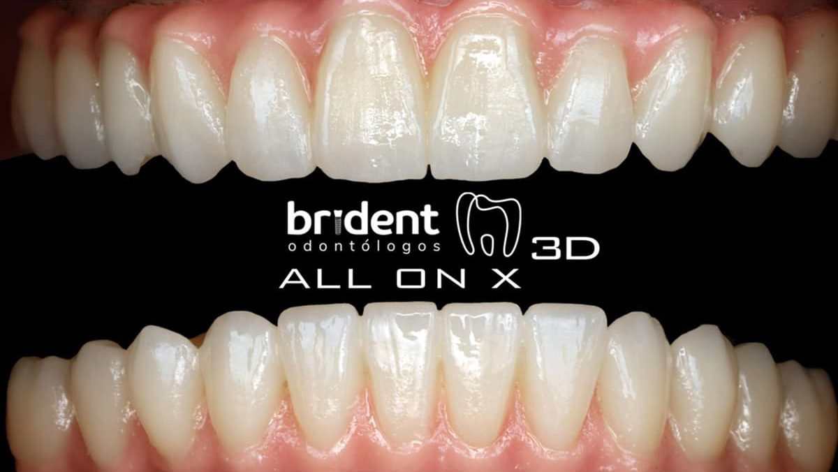 Implantes dentales - All on X