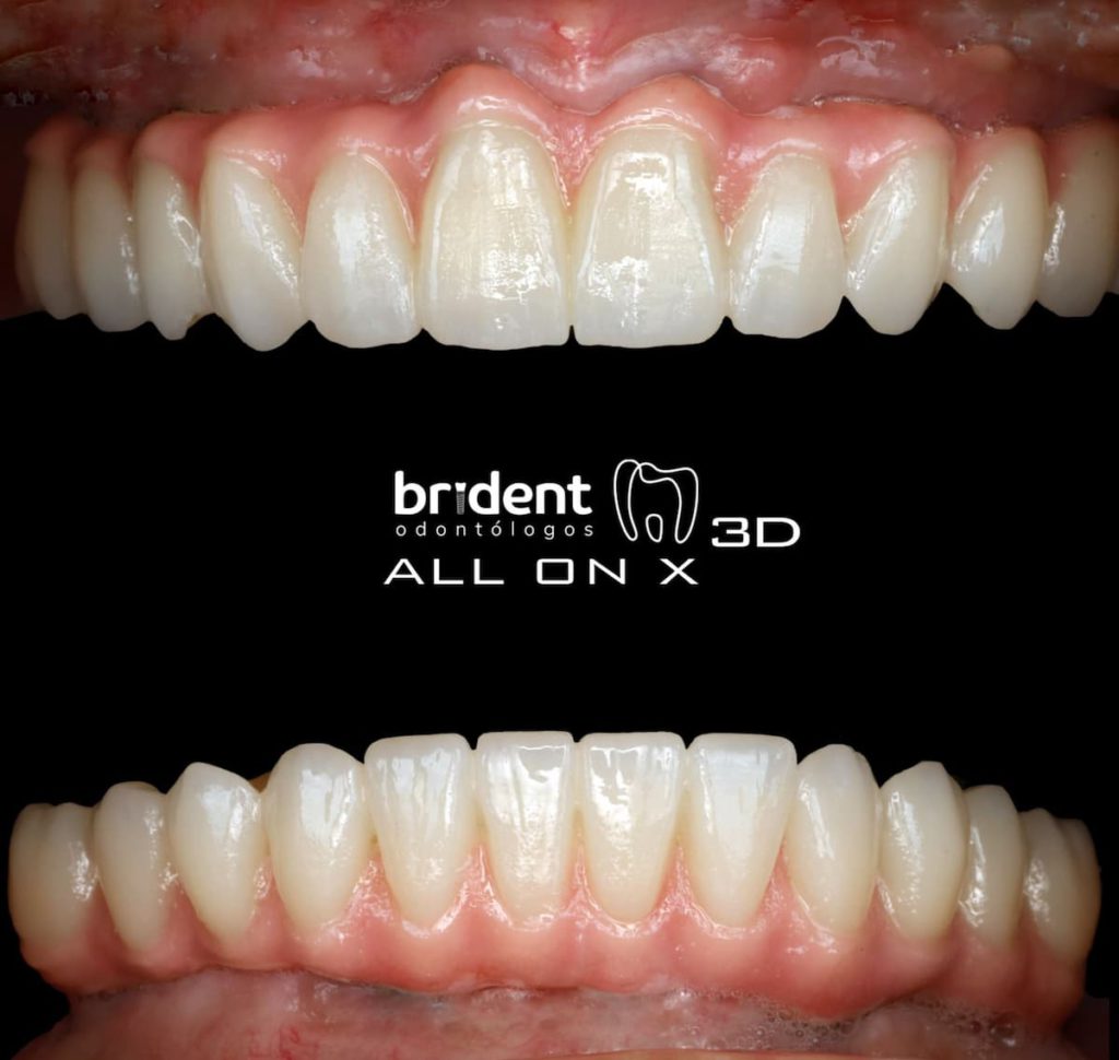 Dentadura completa con implantes dentales