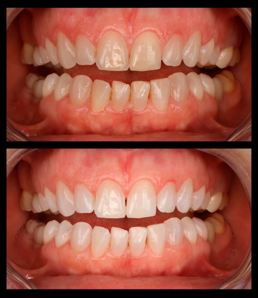 Antes y después Blanqueamiento dental Tenerife
