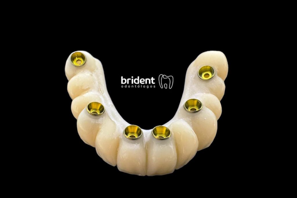 Prótesis más implantes en 24 horas