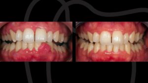 Absceso dental con imágenes del antes y el después