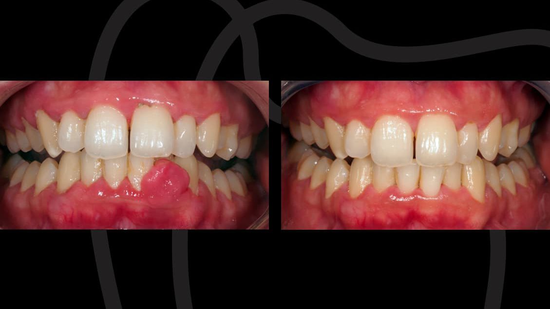 Absceso dental con imágenes del antes y el después