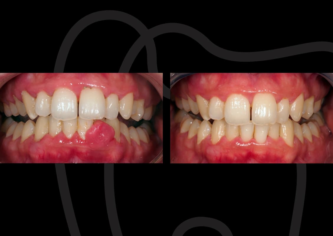 ¿Qué es un absceso dental, síntomas y cura?