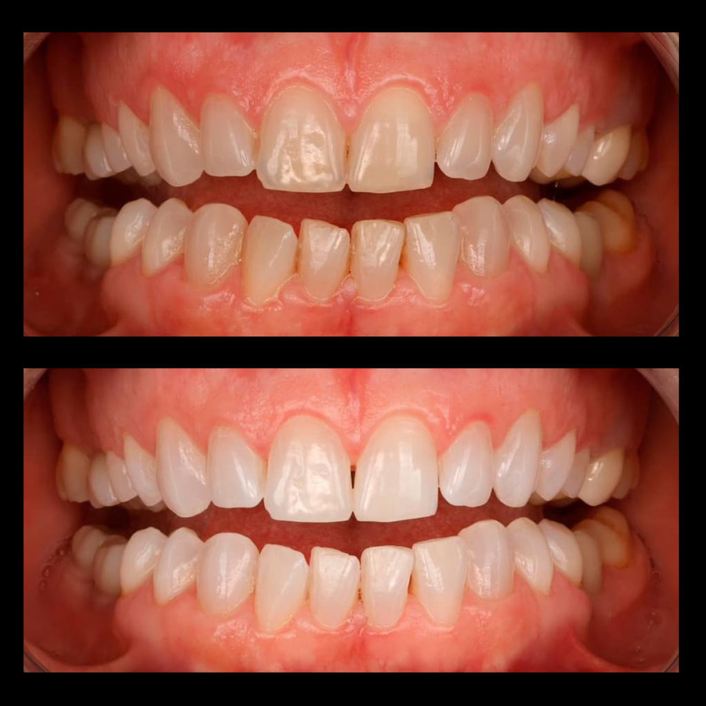 Blanqueamiento dental, ejemplo de como son los tratamientos dentales aplicados a nuestros pacientes