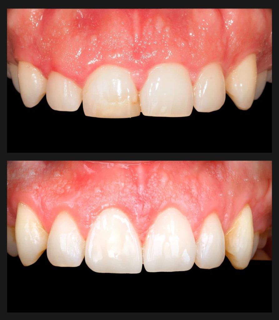 antes y después paciente con carillas dentales