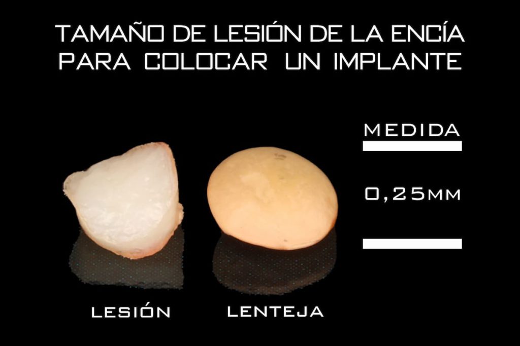 Implantes mínimamente invasivos