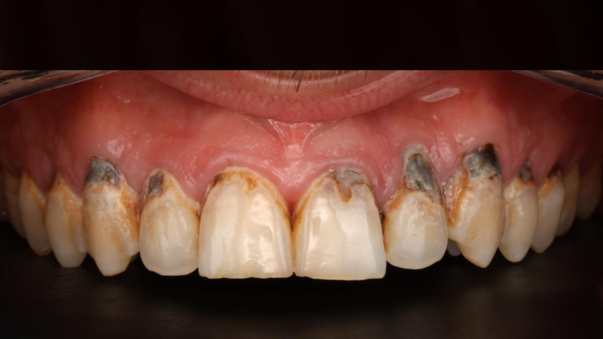 Dientes afectados por el azúcar y el acido de las bebidas energéticas