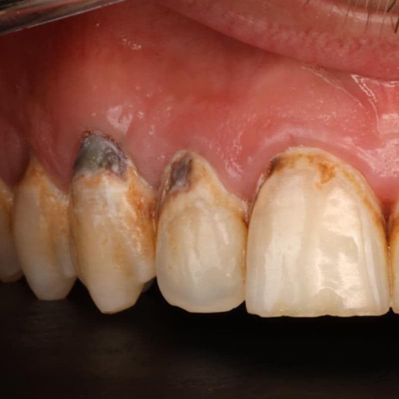 Dientes afectados por el azúcar y el acido de las bebidas energéticas