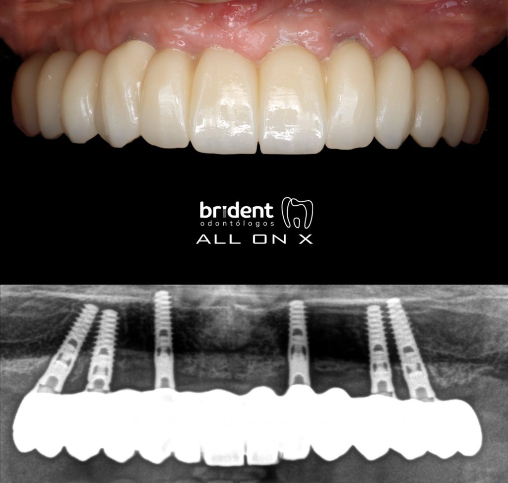 Implantes dentales Tenerife