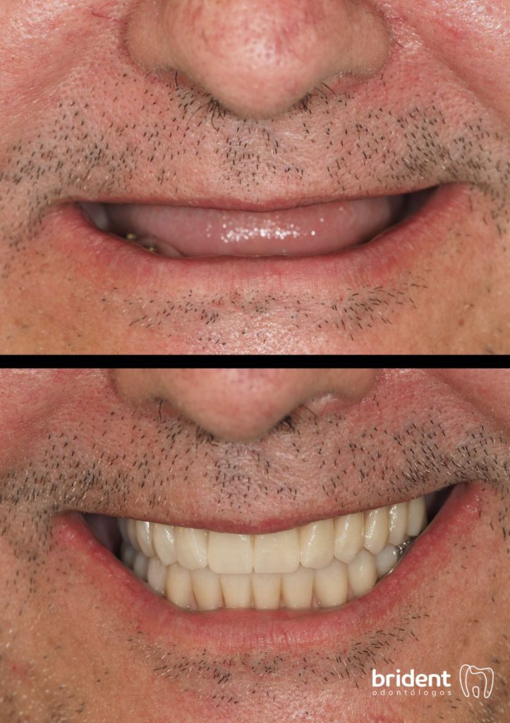 Implantes dentales con poco hueso