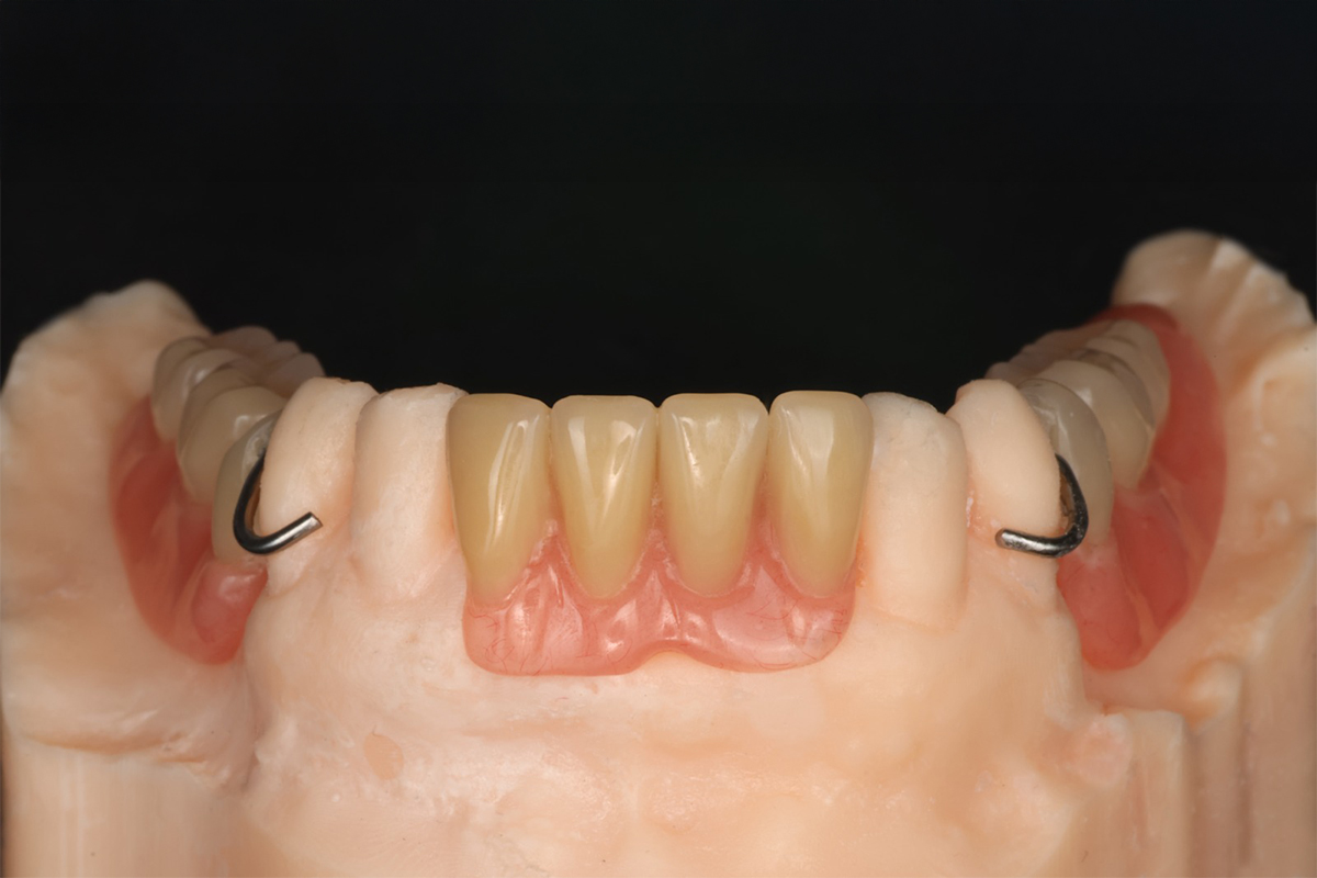 Prótesis dental sobre molde