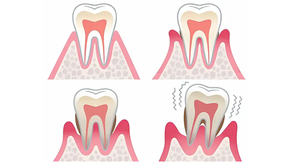 Dientes que se mueven