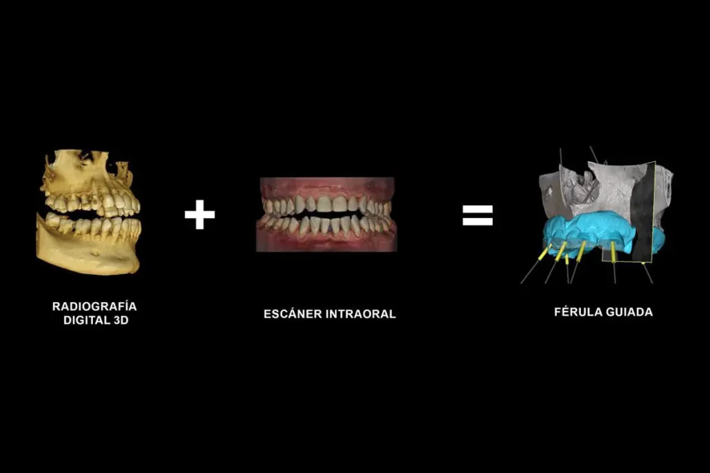 Cirugía Guiada 3D - Clínica Dental Brident Odontólogos