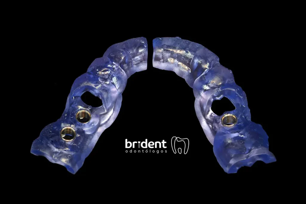 Cirugía Guiada 3D - Clínica Dental Brident Odontólogos