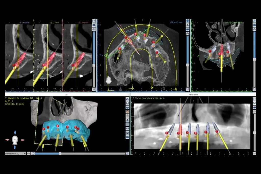 Programa de cirugía guiada 3d de Clínica Dental Brident Odontólogos