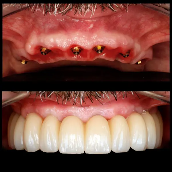 Implantes dentales - Antes y después de colocar los implantes