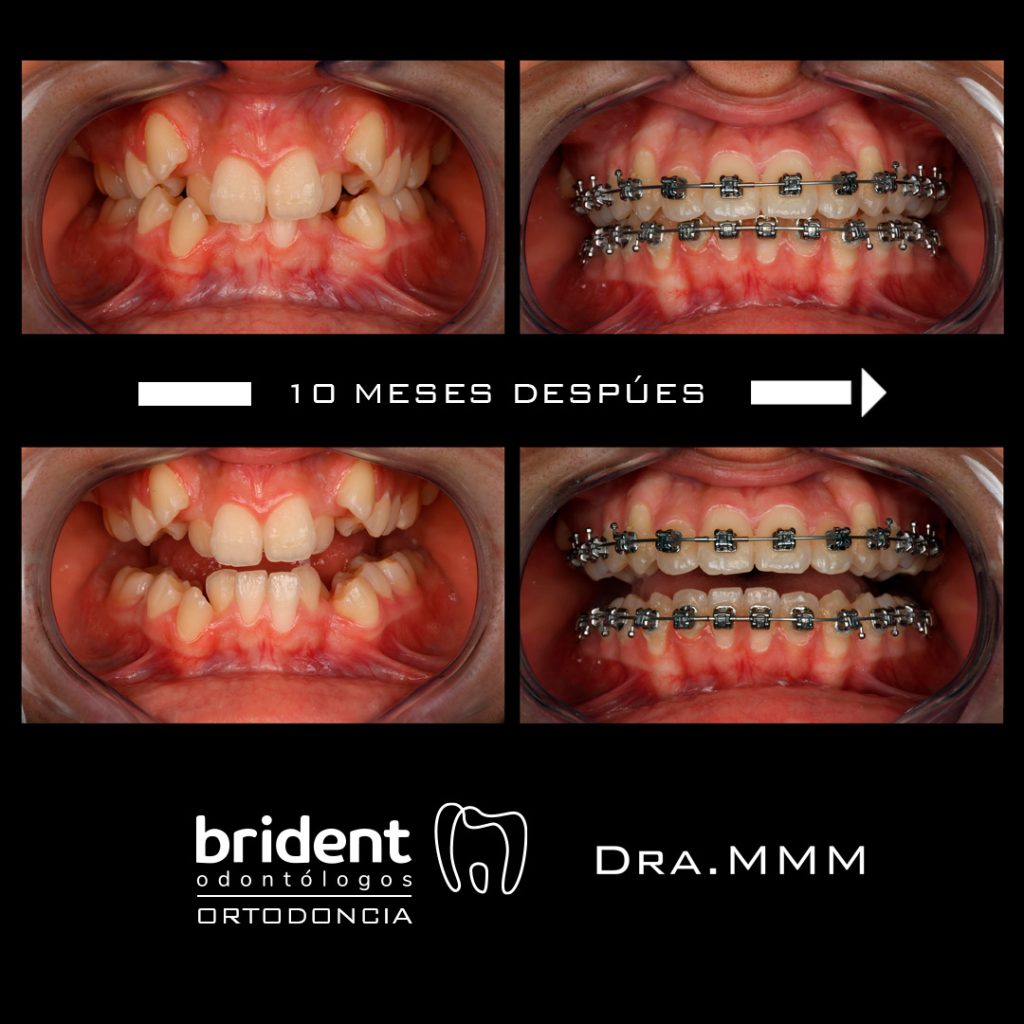 Ortodoncia con brackets caso de antes y después de 10 meses
