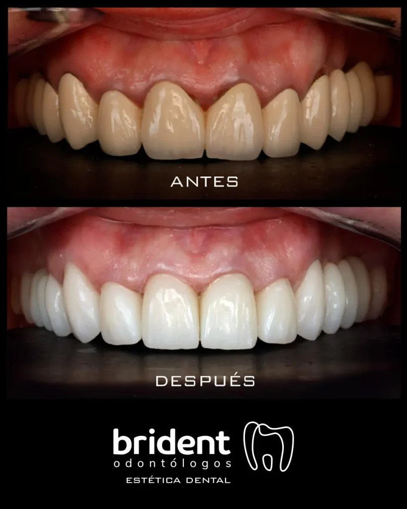 Caso de estética dental donde se muestra un caso de antes y después en un caso de rehabilitación total cerámica del maxilar superior