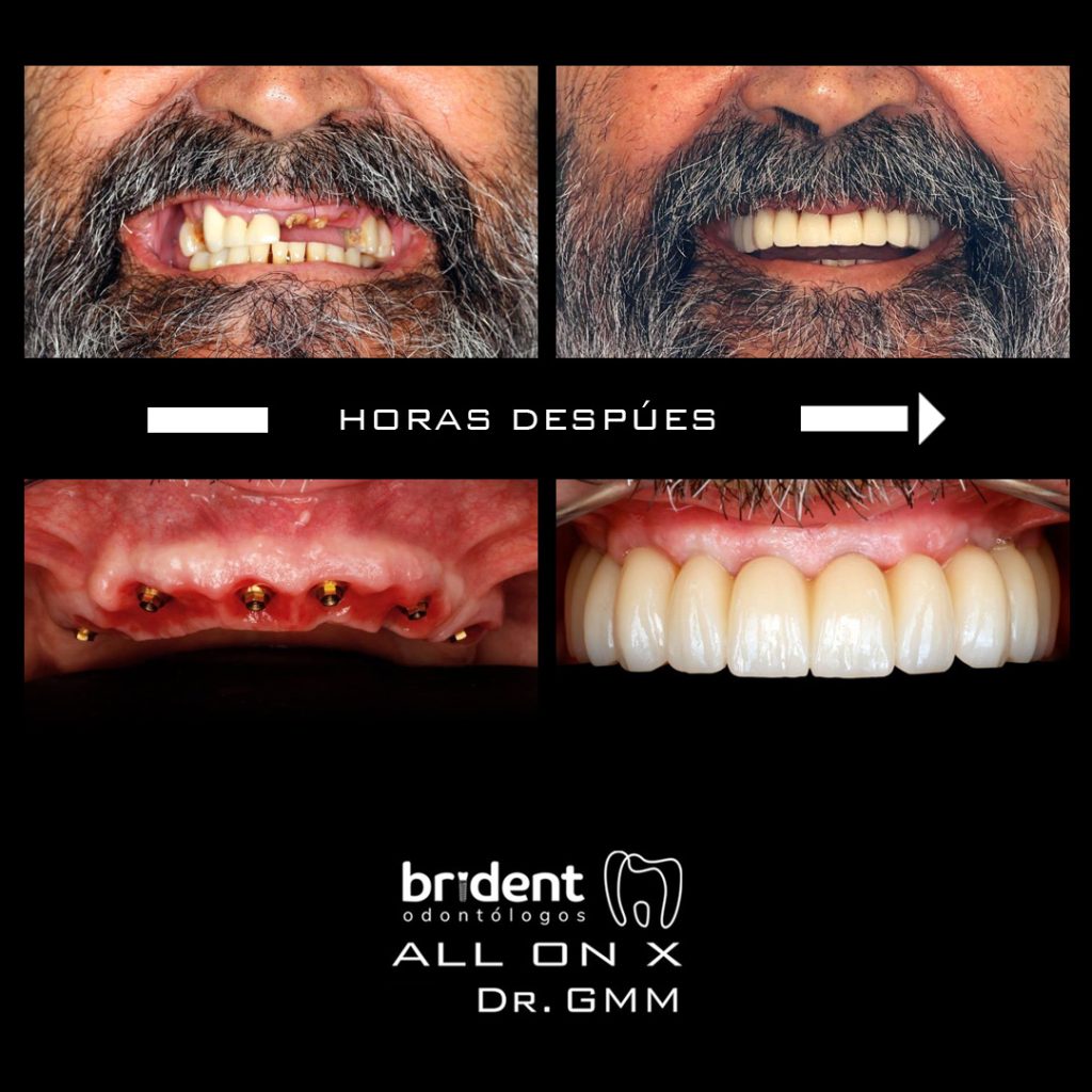 Caso Implante dental All On X - Antes y despues