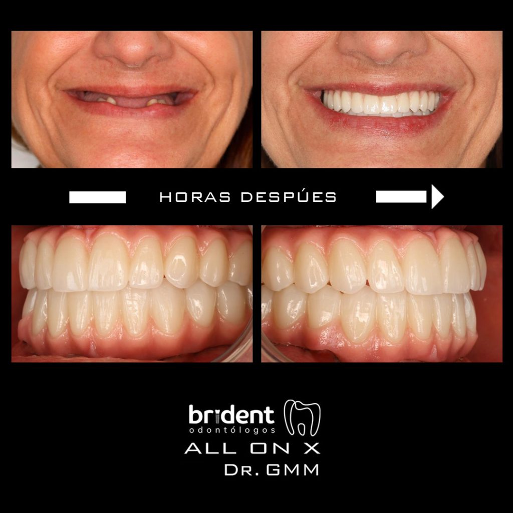 Caso Implante dental All On X - Antes y despues